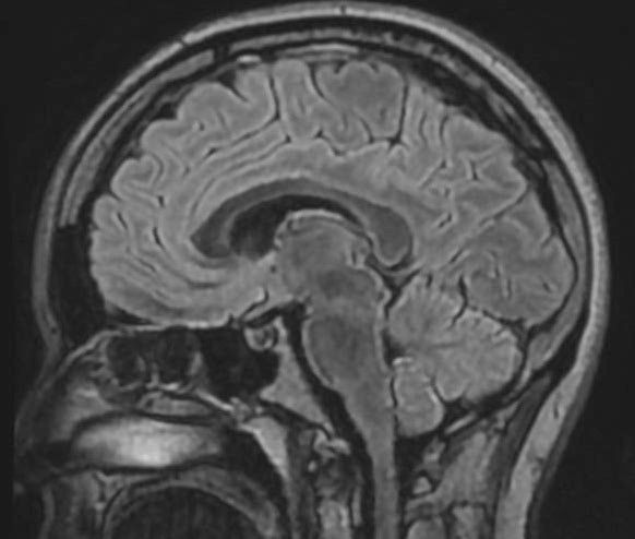 IRM encéphalique | Diamorphos, imagerie médicale à Brest