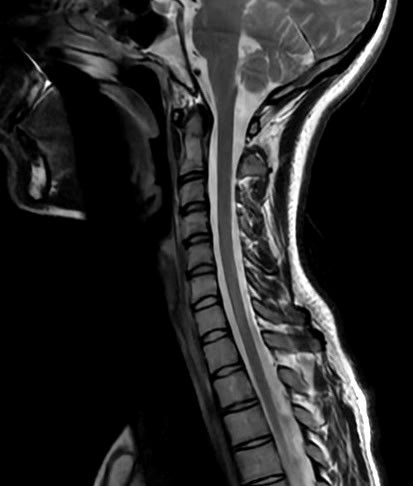 IRM médullaire rachis | Diamorphos, imagerie médicale à Brest